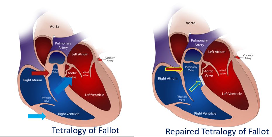 Intracardiac repair of Tetralogy of Fallot