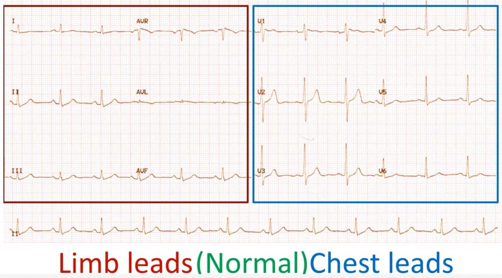 Normal limb and chest leads