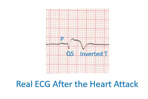 Real ECG after a heart attack