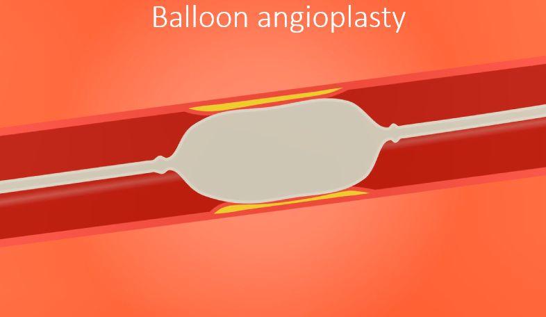 Balloon angioplasty