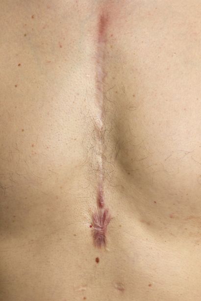 Bypass surgery scar over chest