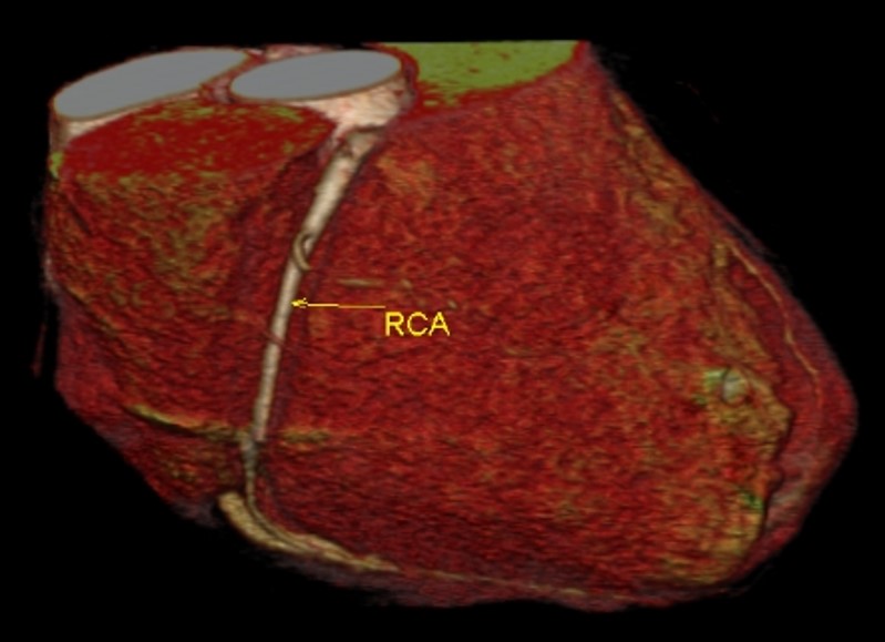CT angiogram - right coronary artery