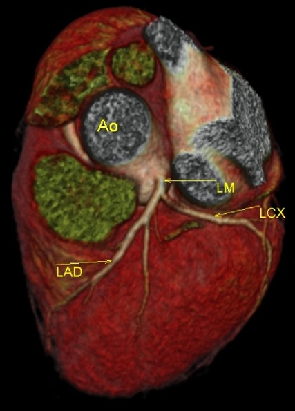 CT angiogram