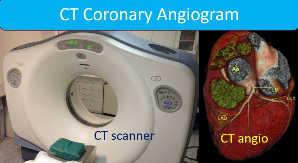 CT coronary angiogram