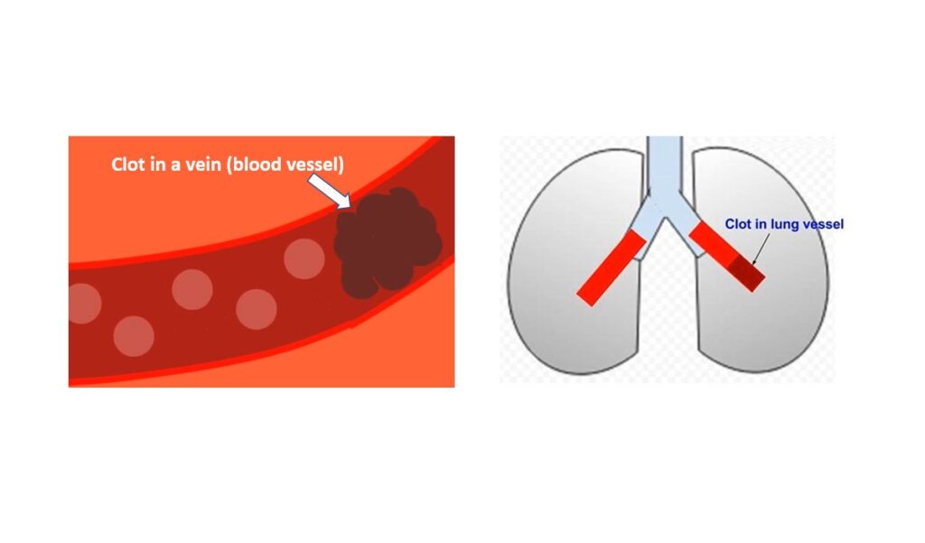 Clot in vein and lungs