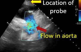 Colour Doppler showing downward flow in aorta