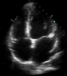 Echocardiogram showing four chambers of the heart