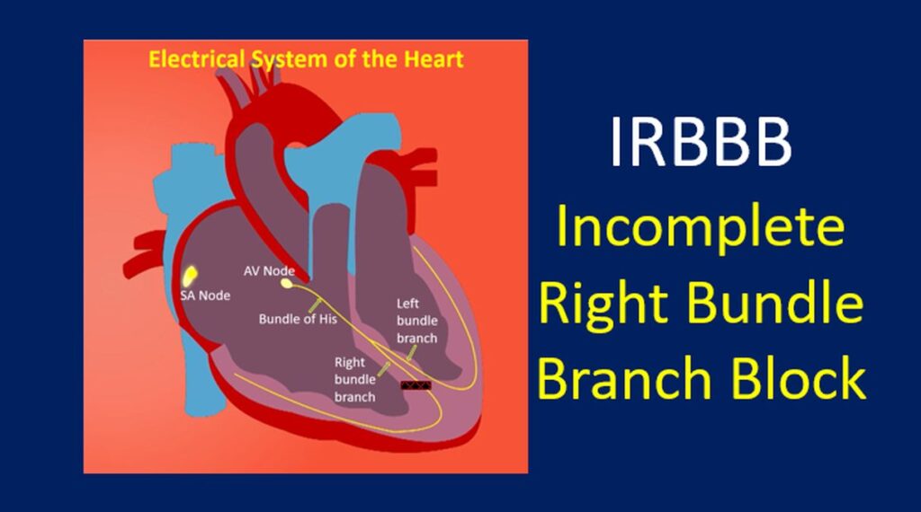 IRBBB - Incomplete Right Bundle Branch Block