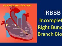 IRBBB - Incomplete Right Bundle Branch Block