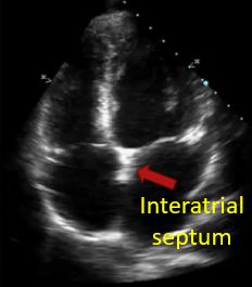 Inter atrial septum