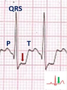 Treadmill Exercise ECG – All About Heart And Blood Vessels