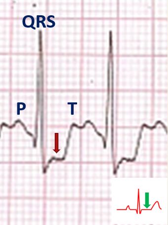 Magnified view of ECG with ST depression