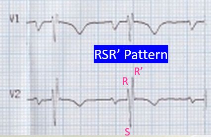 RSR' pattern in ECG