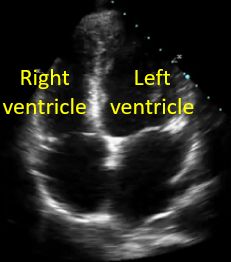 Right and left ventricles