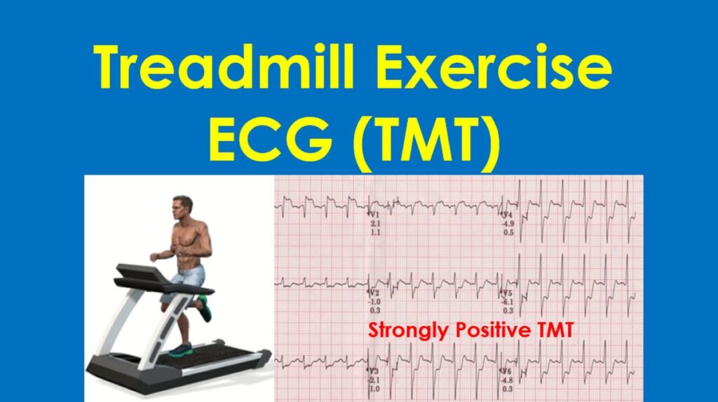 Treadmill exercise ECG