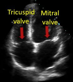 Tricuspid and mitral valves