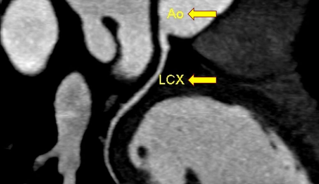 Two dimensional CT image of left circumflex coronary artery