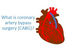 What is coronary artery bypass surgery