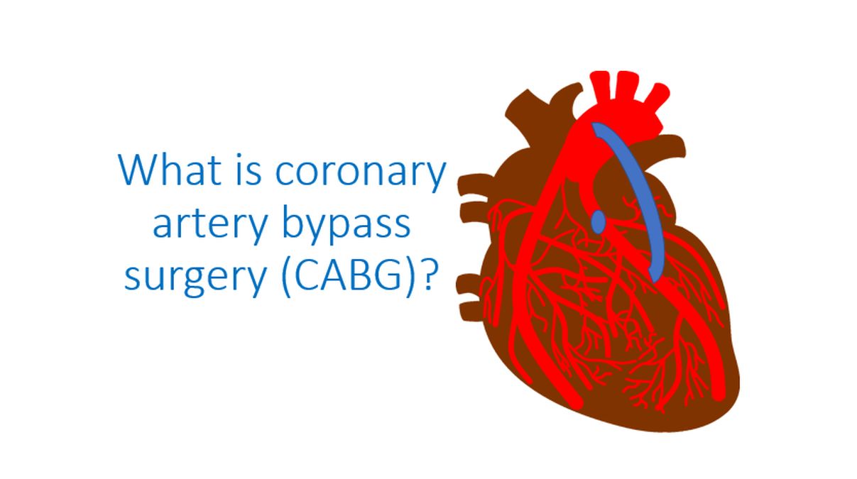 What is coronary artery bypass surgery? - All About Heart And Blood Vessels