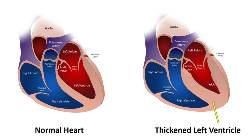 Normal heart and thickened left ventricle in hypertrophic cardiomyopathy