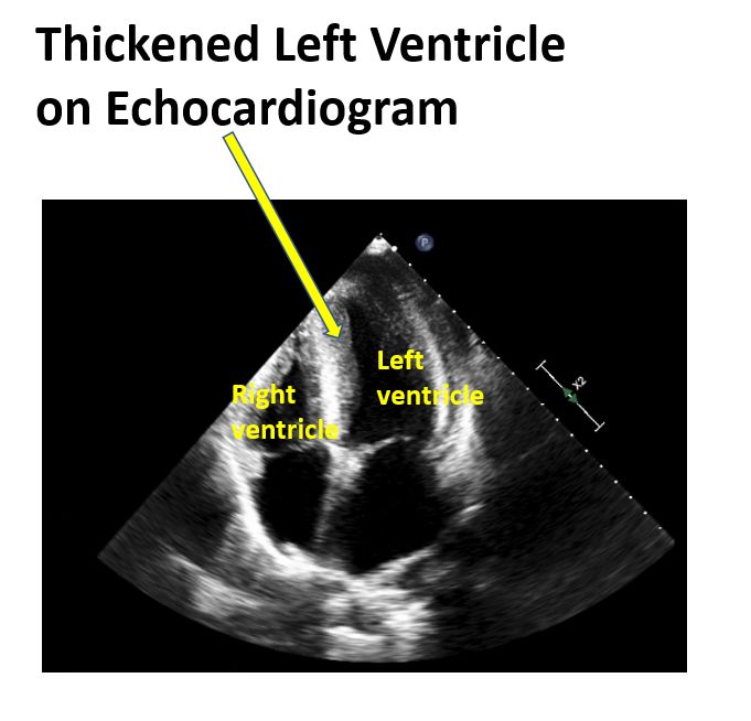 Thickened left ventricle on echocardiogram