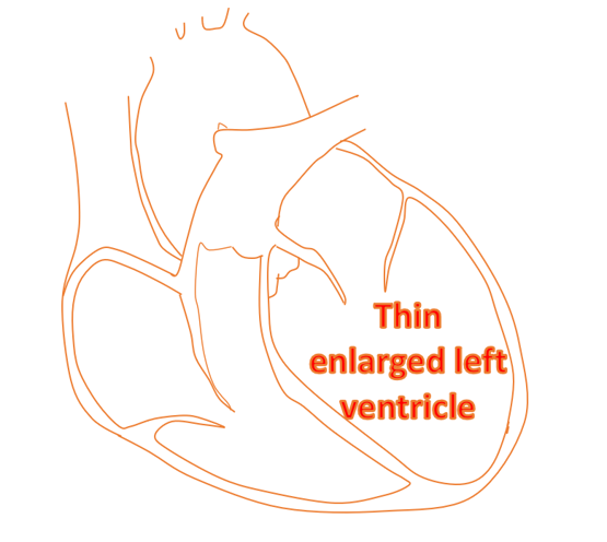 Thin enlarged left ventricle in dilated cardiomyopathy