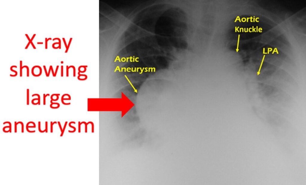 Aneurysm of aorta seen on chest X-ray