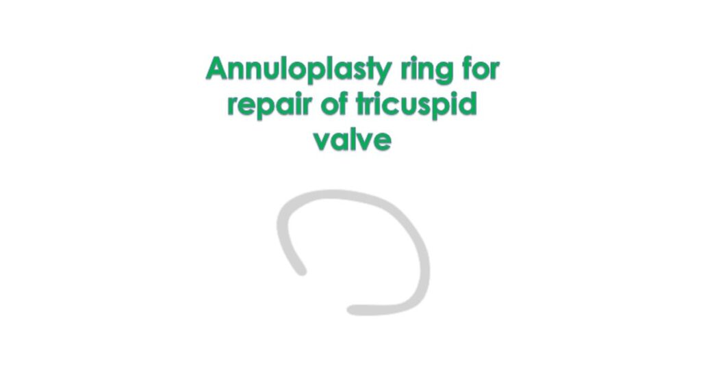 Annuloplasty ring for repair of tricuspid valve