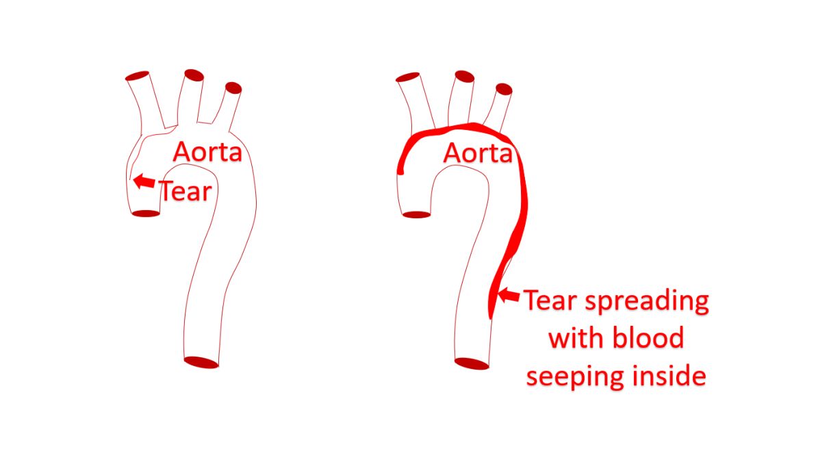 Aortic dissection spreading with blood seeping inside