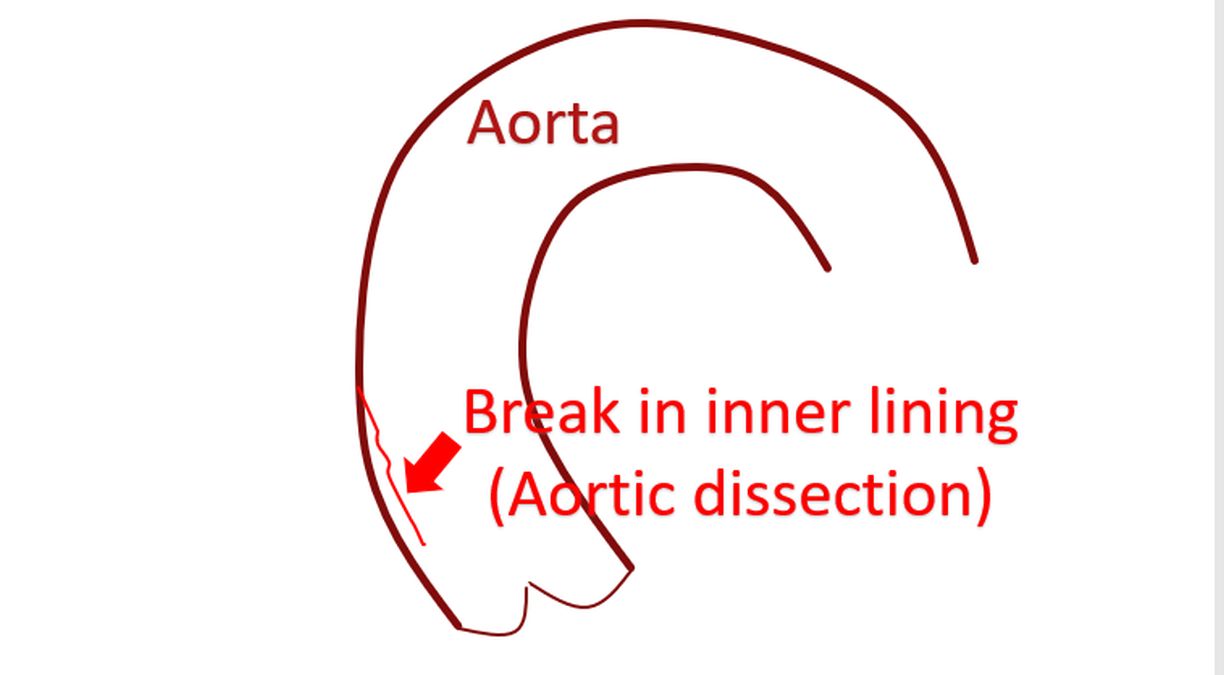 What Is Bicuspid Aortic Valve? – All About Heart And Blood Vessels