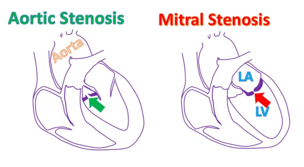 Aortic stenosis and mitral stenosis