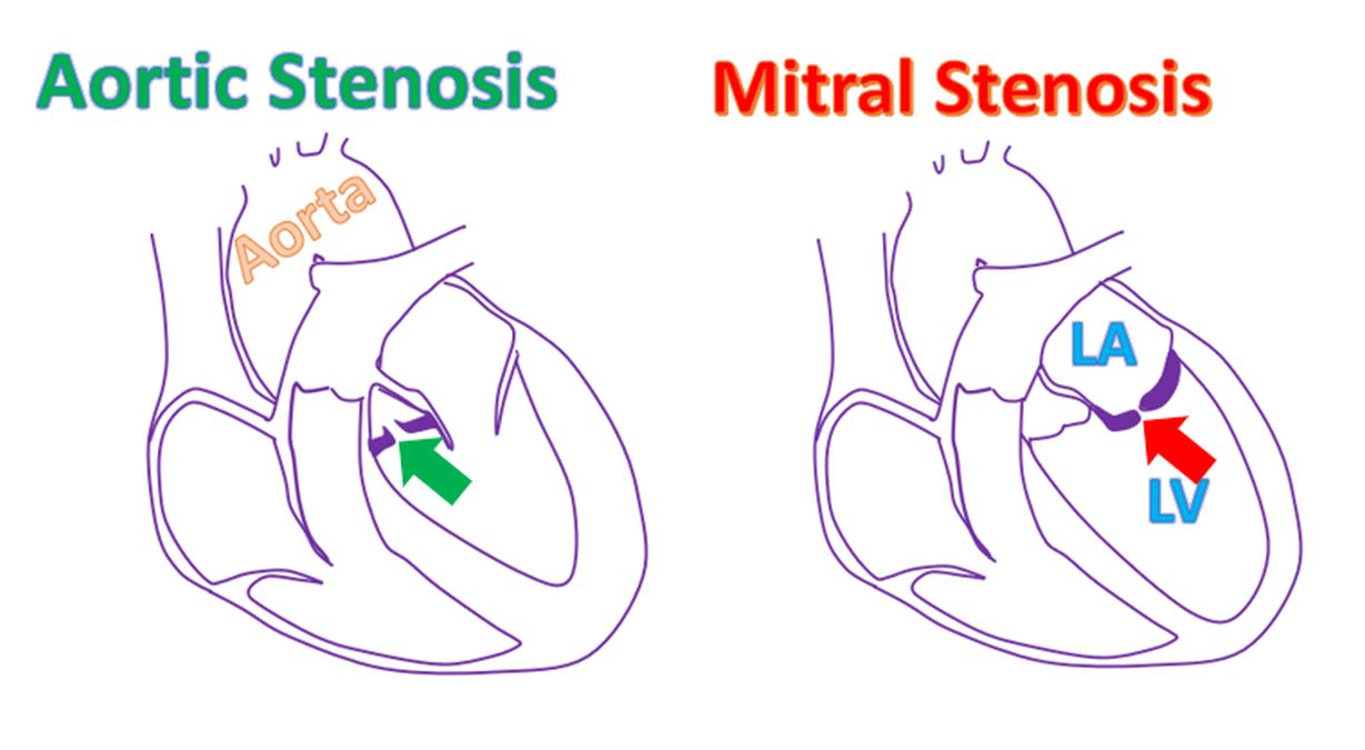 What Is Tricuspid Stenosis? – All About Heart And Blood Vessels