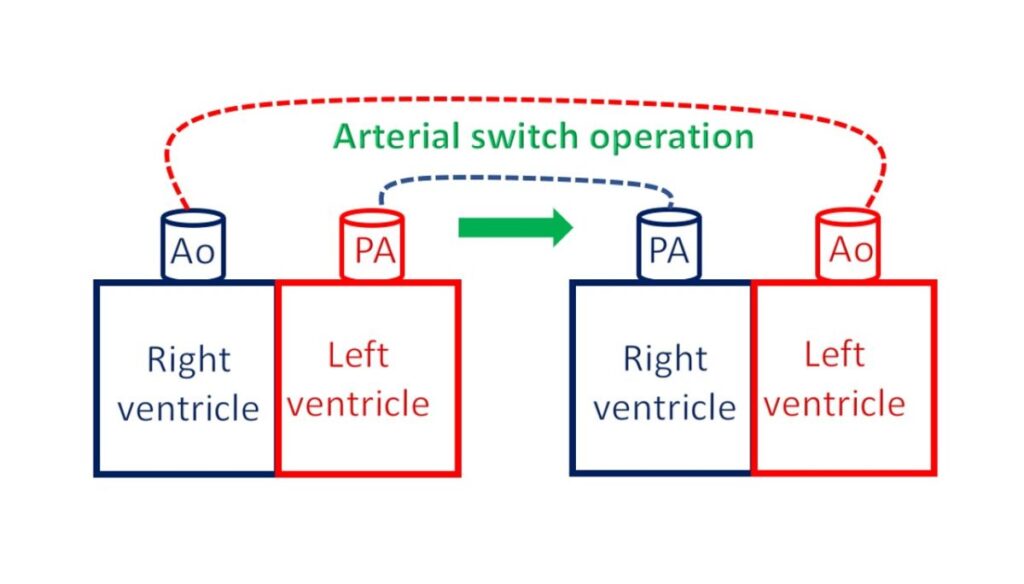 Arterial switch operation