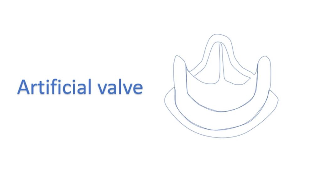 Artificial valve