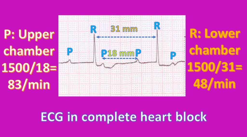 Atrial and ventricular rates in complete heart block