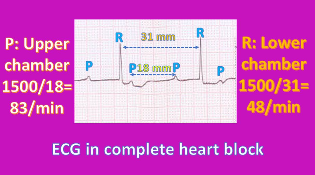 How To Check Heart Rate From The ECG? – All About Heart And Blood Vessels