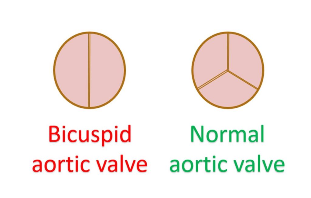 What Is Bicuspid Aortic Valve All About Heart And Blood Vessels