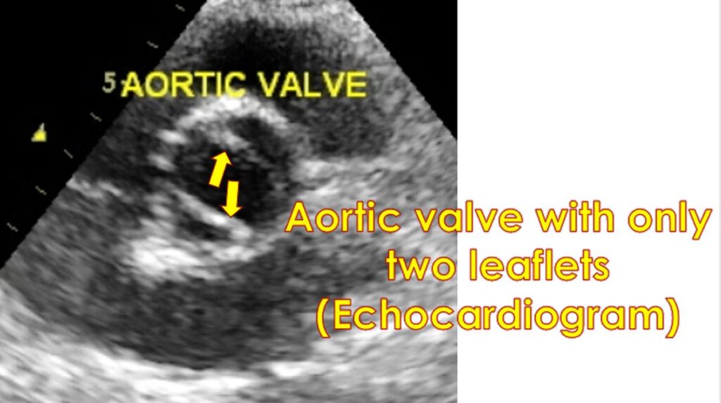 Bicuspid aortic valve (two leaflets) on echocardiogram