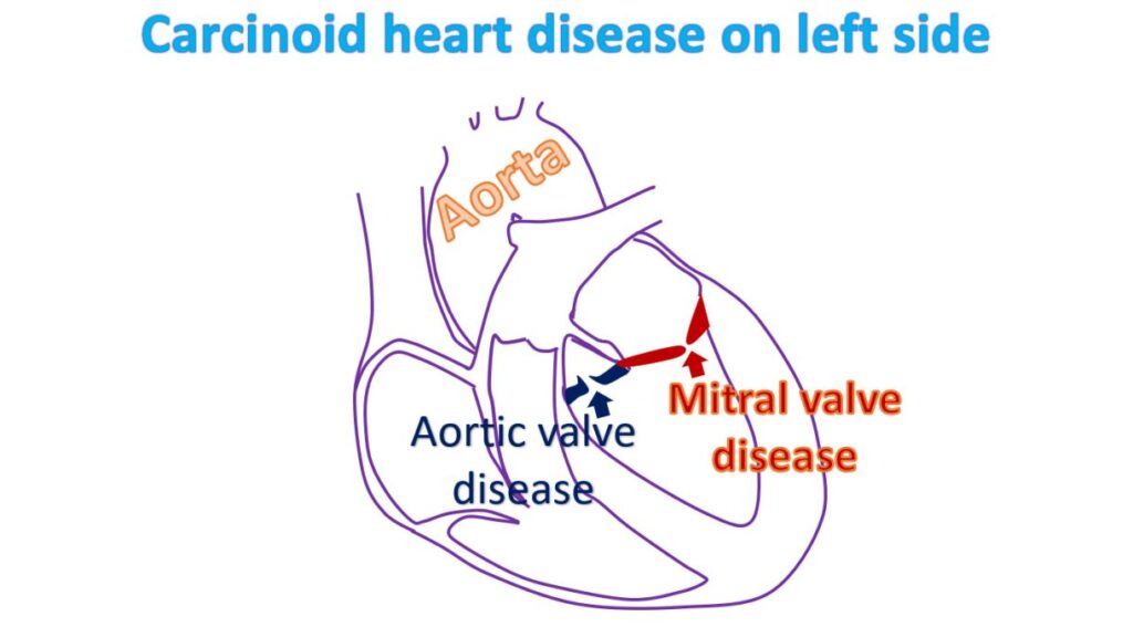 Carcinoid heart disease on left side