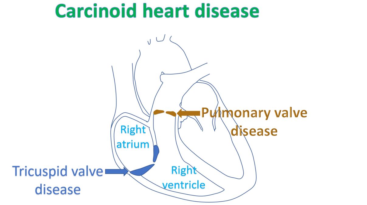 What is carcinoid heart disease? - All About Heart And Blood Vessels