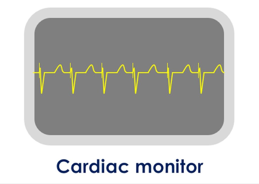 Cardiac m0onitor