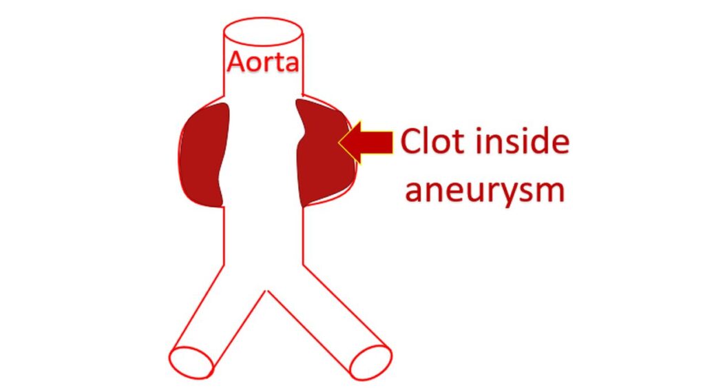 Clot inside abdominal aortic aneurysm (AAA)