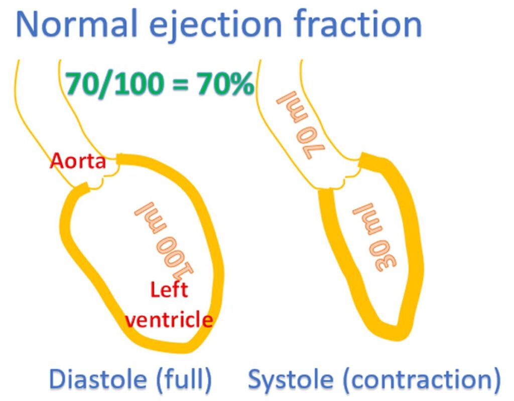 Demonstration of ejection fraction