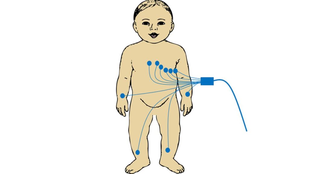 ECG electrodes for a baby