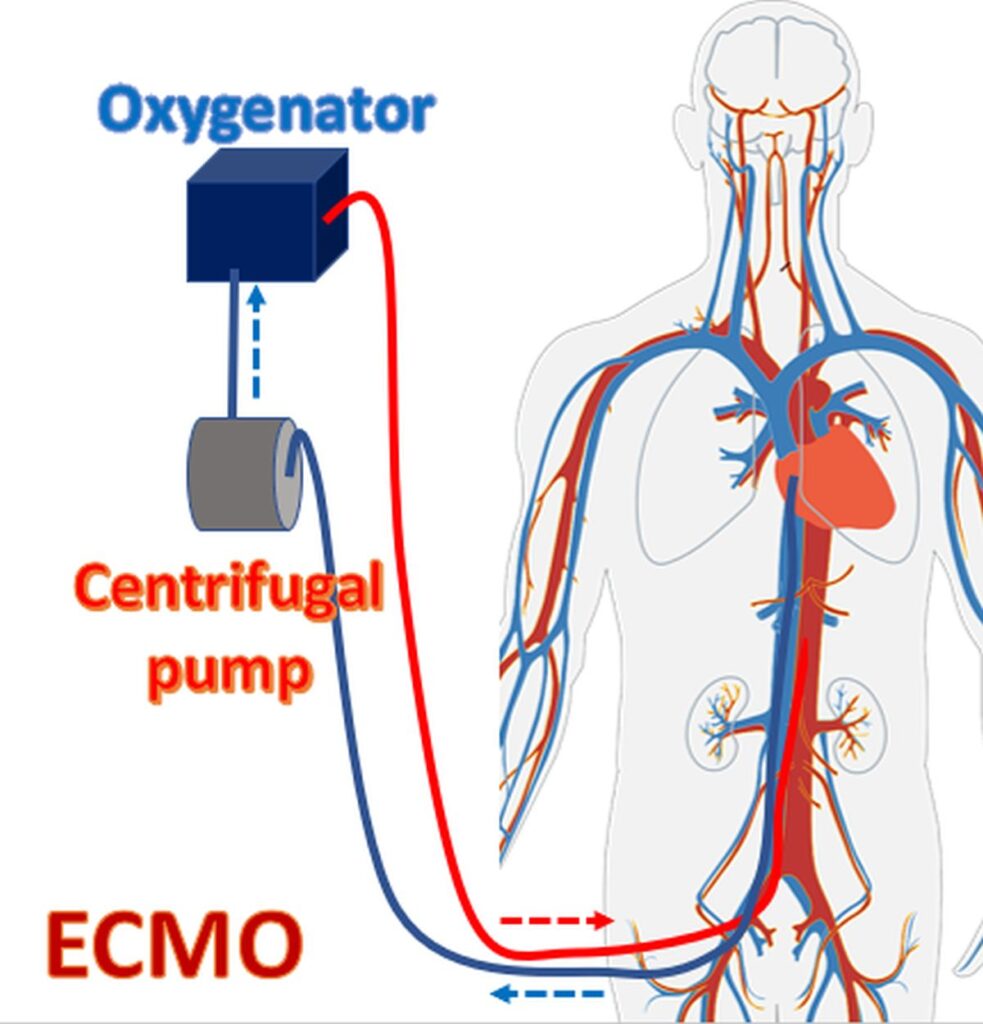 Extracorporeal membrane oxygenator (ECMO)
