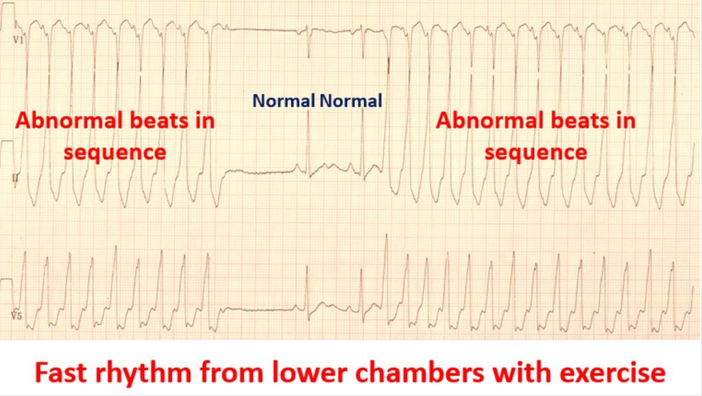 Fast rhythm from lower chambers (ventricular tachycardia) during exercise