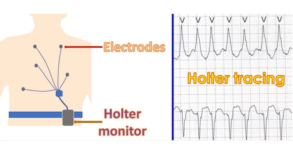 Holter monitoring