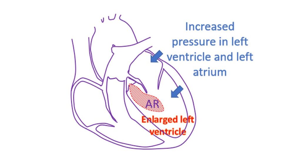 Increased pressure in left ventricle and left atrium