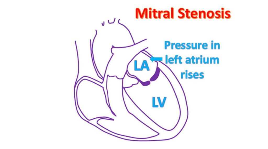 Mitral stenosis - left atrial pressure rises