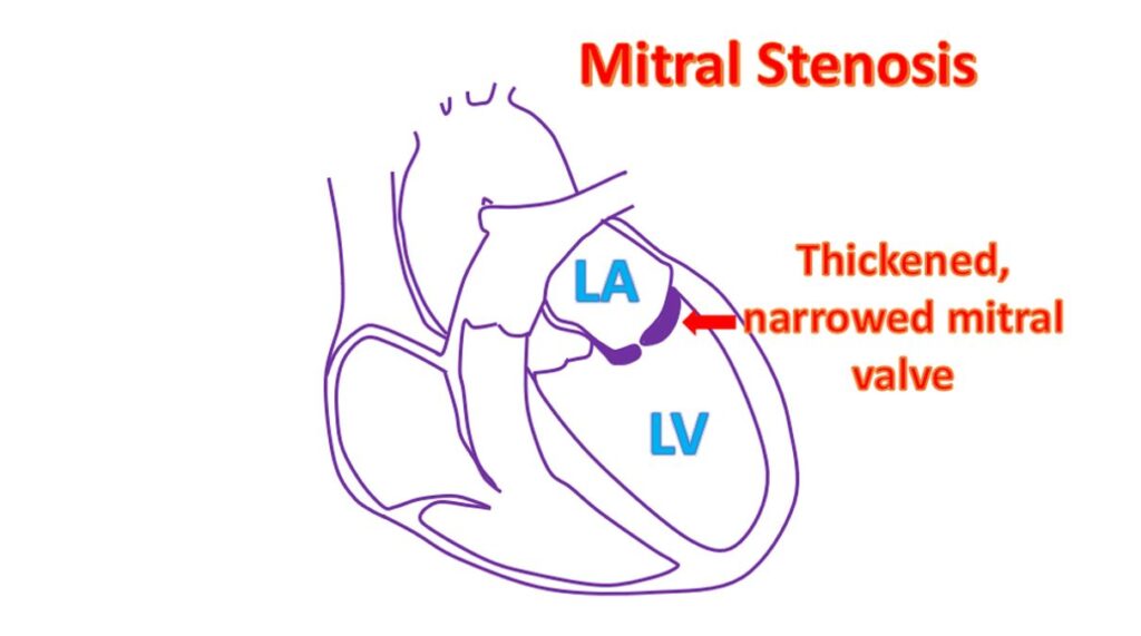 Mitral stenosis - schematic diagram